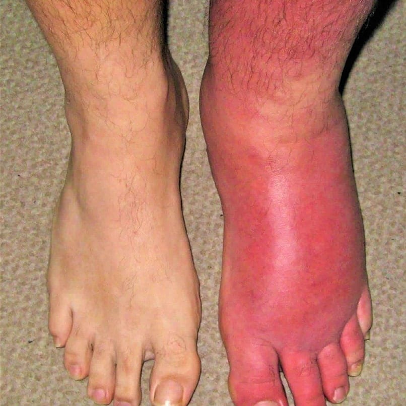 Cellulitis - Types, Causes, Treatment, Diagnosis & Prevention Cellulitis - Types, Causes, Treatment, Diagnosis & Prevention