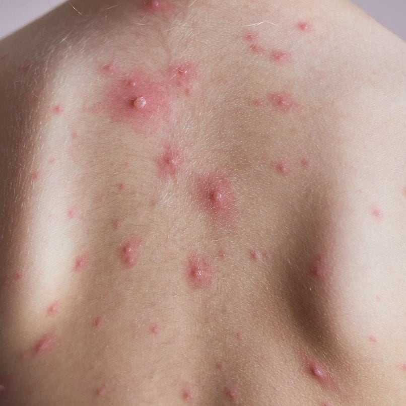 Chickenpox