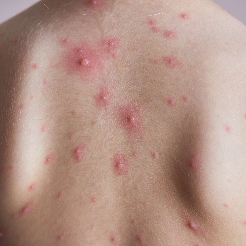 Chicken pox symptoms