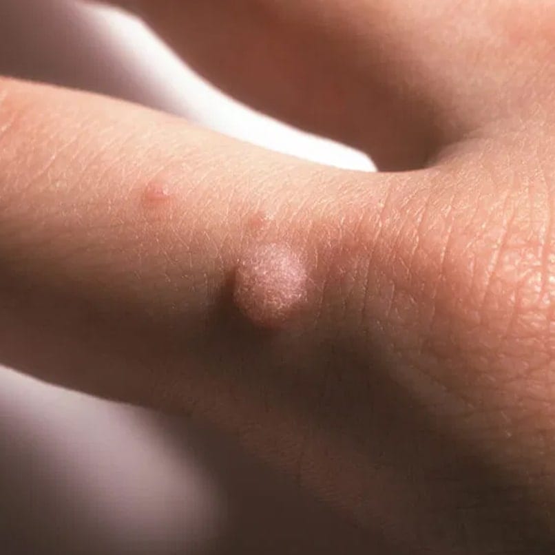 vph en boca imagenes curatarea intestinelor cu apa cu sare