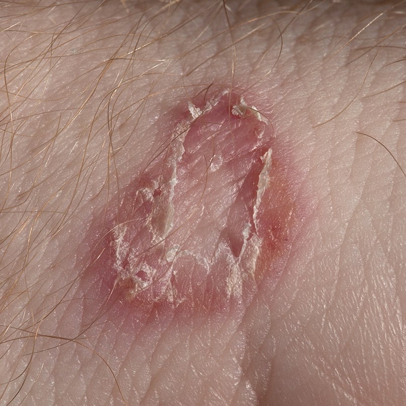 Ringworm Infection