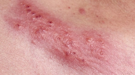 Symptoms herpes genital What are