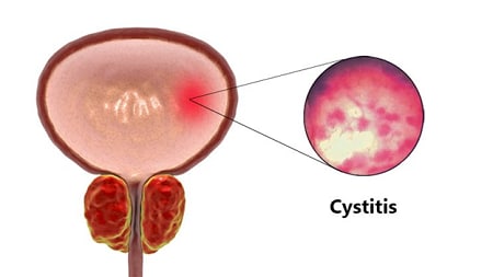 Meaning cystitis Cystitis symptoms